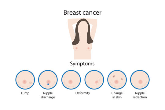 Breast Cancer And Its Symptoms