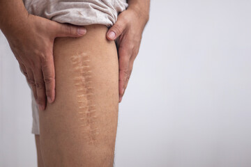 Scar caused by leg surgery - obrazy, fototapety, plakaty