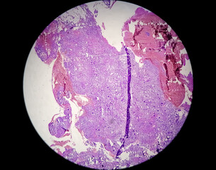 Spinal tumor biopsy: Psammomatous meningioma. Psammoma bodies.