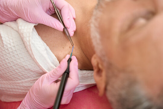 Dermatologist surgeon removes mole man neck with radioknife scalped method