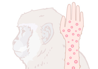 サル痘のイメージイラスト