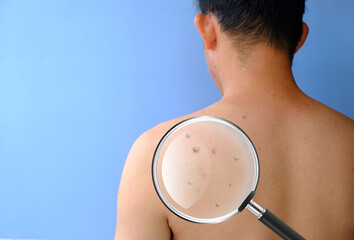 Health problems, skin disease, young man reappears with acne, Monkeypox is a new and dangerous...