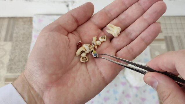 Dentist holds and shows many extracted teeth in the palm of his hand. Molar and milk teeth with fillings on the palm