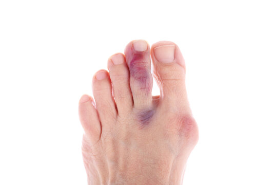 Bruised injured middle toe, big toe with bunion