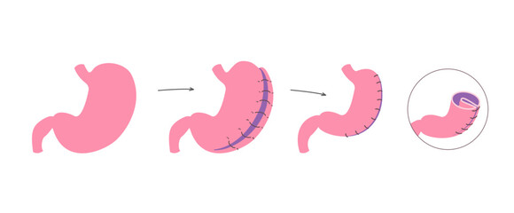 Gastric plication flat infographics. The explanation picture of stomach reduce method via laparoscopic operation