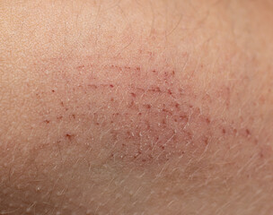 scratches on the skin as a background