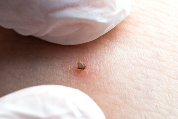 Sucking tick Macro photo on human skin. Ixodes ricinus. Bloated parasite bitten into pink irritated...