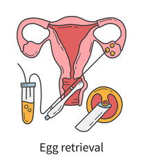 Egg retrieval and transvaginal oocyte extraction from ovaries, In Vitro fertilization IVF vector illustration in doodle hand drawn style