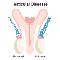 Varicocele. Testicular Disease, enlargement of the veins in the scrotum