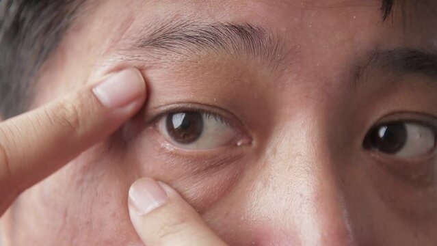 Asian men have dry eyes. concept of eye disease Eye health check. Chronic glaucoma in people aged 40 years. Skin disease, acne problems.