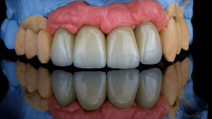 Four dental crowns of central teeth ceramics on a plaster from gypsum and pink gums on glass with a...