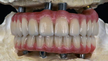 Dental prostheses of two jaws of ceramics and titanium with an artificial gum in a bite