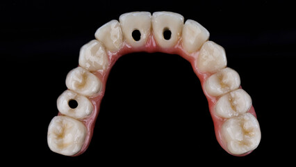 View from above on the morphology of the teeth of the prosthesis of the upper jaw on a black background © Dental Pro Content