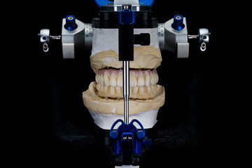 Dendal Articulator with a prosthesis of zircon of the upper jaw and a temporary prosthesis of the lower jaw on a black background © Dental Pro Content