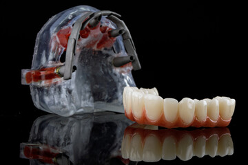 temporary dental prosthesis of the upper jaw with gums and a model with a collapsible beam on black glass with reflection © Dental Pro Content