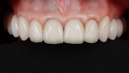 upper jaw with ceramic veneers and crowns on a black background