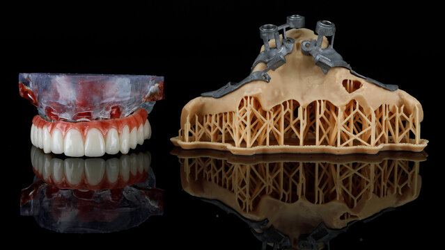 excellent dental prosthesis of the upper jaw on the model and metal templates for zygomatic implantation on a black background
