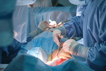 Team of professional doctors operating a patient conducting open cut surgery in surgical room....