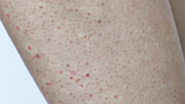 Close-up of the leg skin covered with red rash, pimples and irritation. Concept of scabies, allergy and cosmetology.