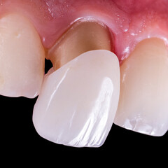single ceramic crown bl1 color