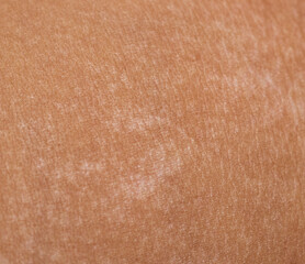 pigment spots on the skin after a sunburn