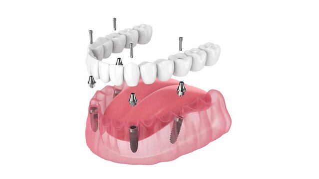 Dental prosthesis all-on-4 system supported by implants