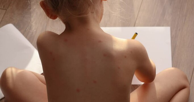 five-year-old girl with chickenpox, measles, Monkeypox virus. Sick child with chickenpox.