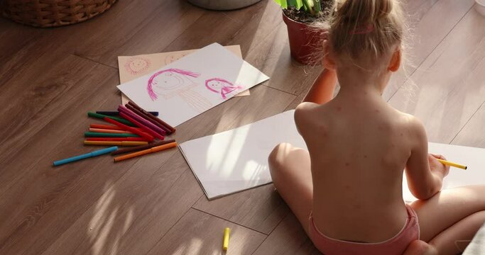 Girl at home in isolation draws with felt-tip pens. Five-year-old girl with chickenpox, measles, Monkeypox virus.