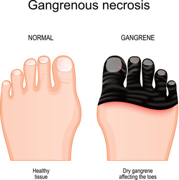 Gangrene affecting the toes.. tissue death by Gangrenous necrosis