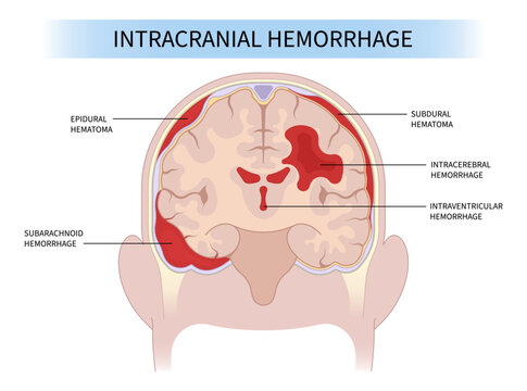 Brain traumatic injury and High blood pressure Loss of sickle cell anemia cancer tumor dura mater skull fracture hit fall exam bleed venous sinus thrombosis basal ganglia CT scan Tomography meninges