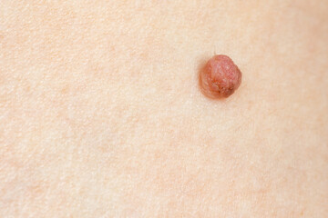 Macro close ups of moles on caucasian skin with a shallow depth of field and copy space