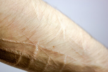 Scars from cuts on the arm. suicide.Cut marks on arms.