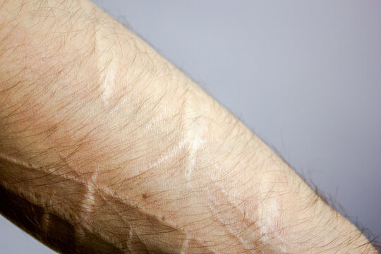 Scars from cuts on the arm. suicide.Cut marks on arms.