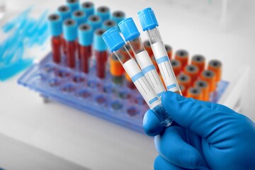 Positive blood infection sample in test tube for CENTAURUS BA 2.75 omicron covid19 coronavirus in lab. Scientist check and analyze for patient in hospital.