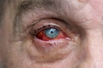 Eye of a man with injured conjunctiva due to an accident, sutured with several stitches and blood shot after surgery, health and medical theme, selected focus