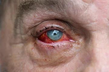 Fotobehang Eye of a man with injured conjunctiva due to an accident, sutured with several stitches and blood shot after surgery, health and medical theme, selected focus © Maren Winter
