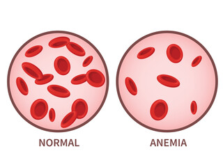 Hemoglobin. Anemia symptoms, blood disease. Health care concept.