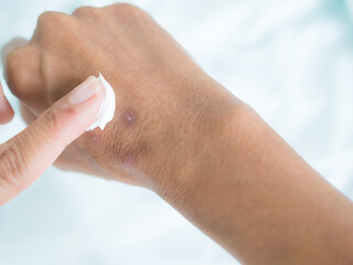 Scar on hand woman. finger applying removal blister wound on skin body with blue background. drug...