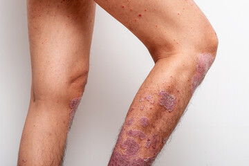Psoriasis is that knee on white background.