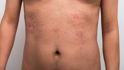 Psoriasis is the abdomen on white background.