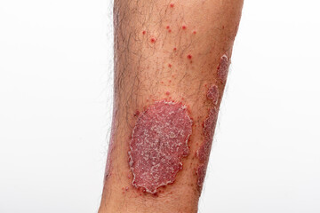 Psoriasis is that knee on white background.