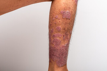 Psoriasis is that knee on white background.