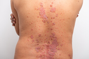 Psoriasis is that back on white background.
