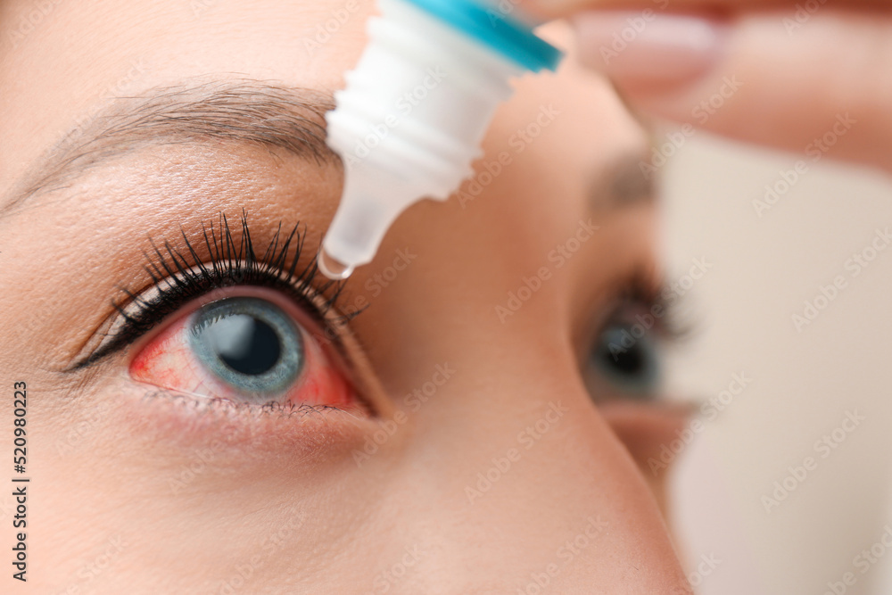 Wall mural Closeup view of woman with inflamed eyes using drops