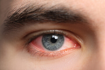 Closeup view of man with inflamed eyes