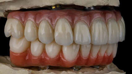 dental prostheses from zircon and titanium in the bite on models side view