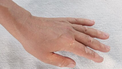 woman female models with vitiligo disease turning hands on a side and another.gray blanket background,sunny summer day,tree shadows.skin depigmentation,symptoms causes treatment,medical concept