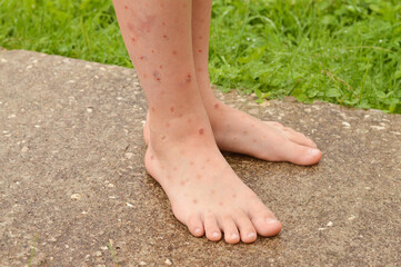 Close-up of children's legs strewn with ulcers and sores, combed from insect bites. - obrazy, fototapety, plakaty