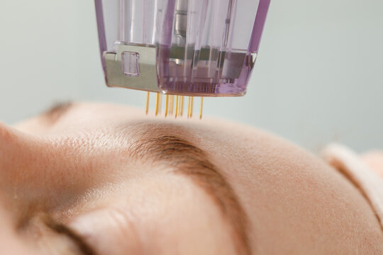 Microneedle mesotherapy. Woman receiving micro needling rejuvenation treatment in a cosmetology clinic.
