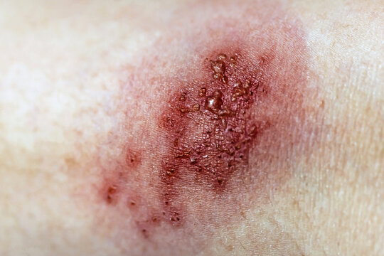 Skin infected Herpes zoster virus